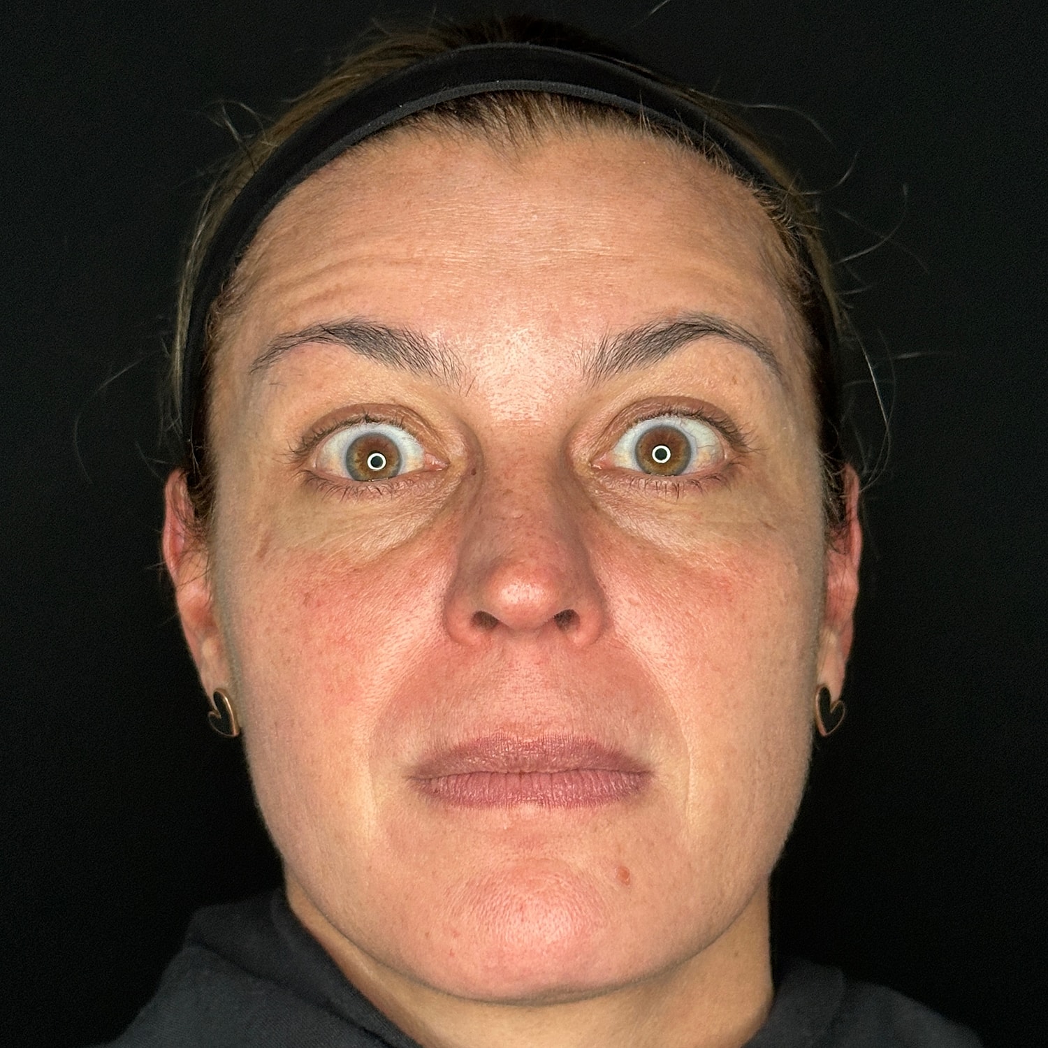 Botox Before & After