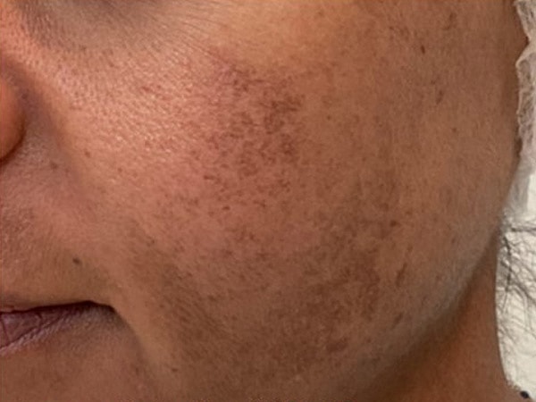 UltraClear Before & After