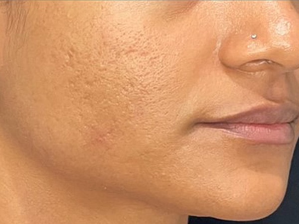 UltraClear Before & After