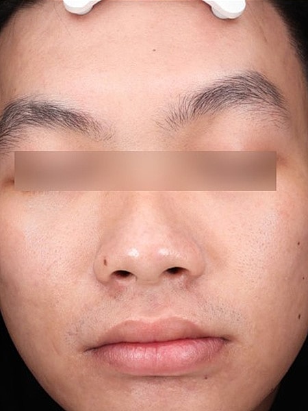 UltraClear Before & After