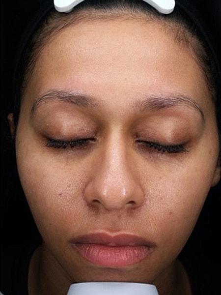 UltraClear Before & After