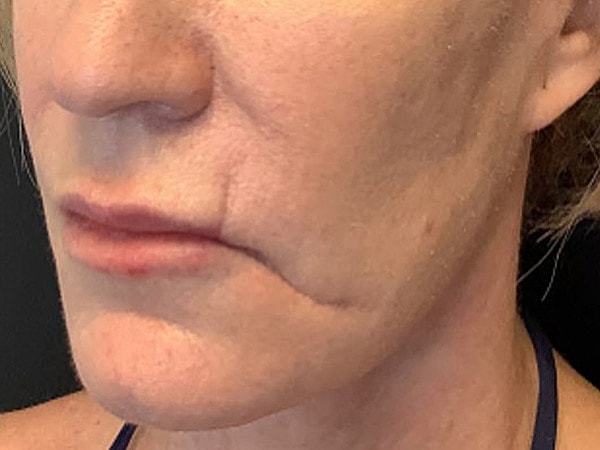 UltraClear Before & After