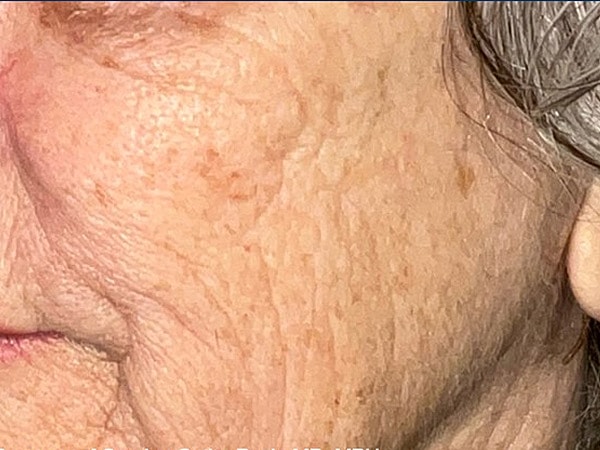 UltraClear Before & After