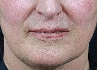 Close-up of an aging person's lower face.