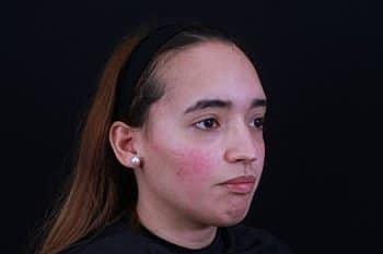 Skin Rejuvenation Before & After