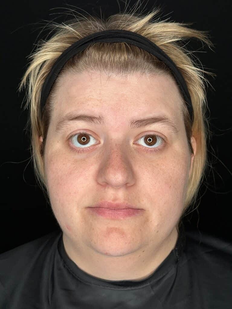 Skin Rejuvenation Before & After