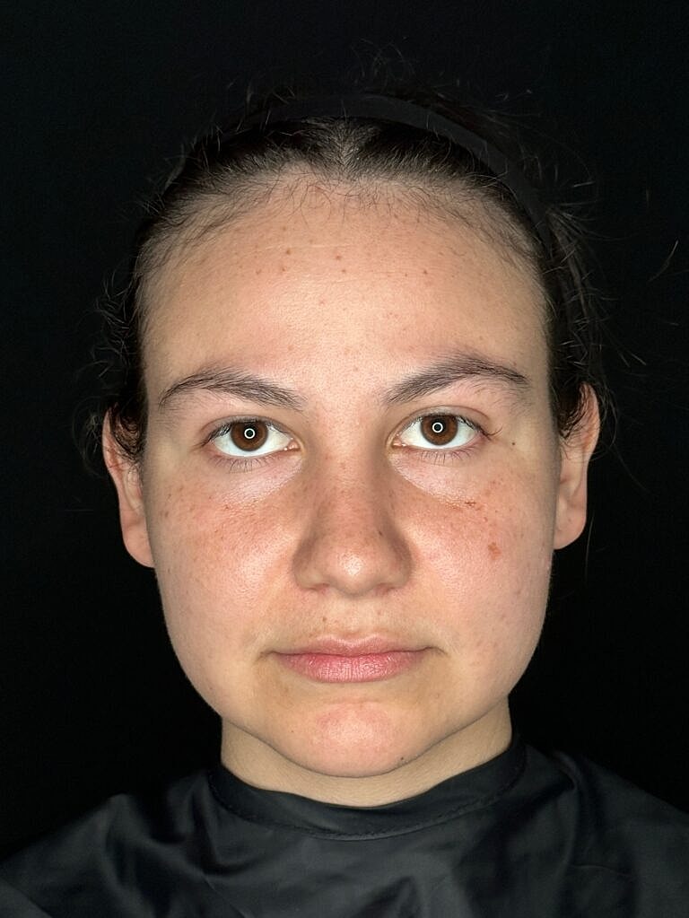 Skin Rejuvenation Before & After