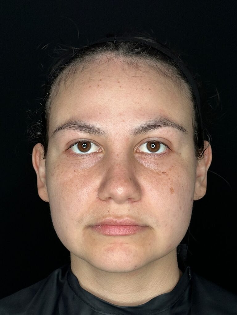 Skin Rejuvenation Before & After