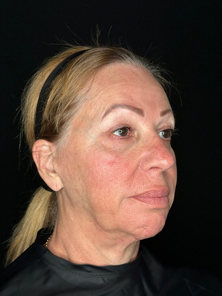 Skin Rejuvenation Before & After