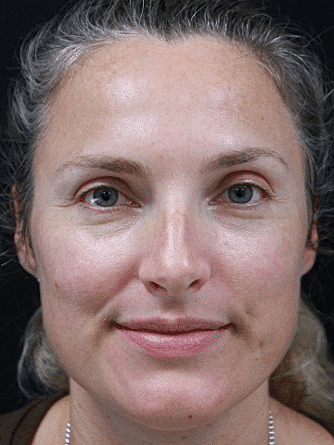 Skin Rejuvenation Before & After