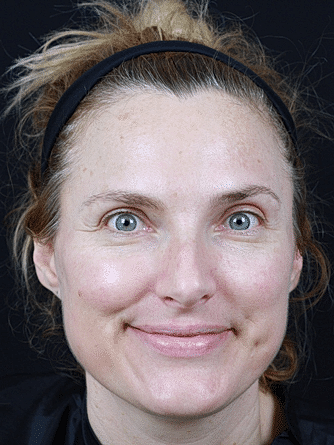 Skin Rejuvenation Before & After