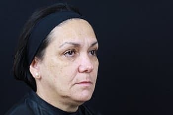 Skin Rejuvenation Before & After