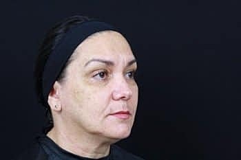 Skin Rejuvenation Before & After