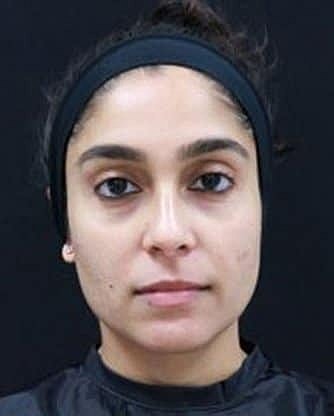 Skin Rejuvenation Before & After