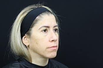 Skin Rejuvenation Before & After