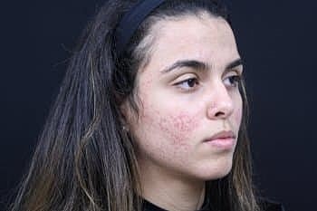 Skin Rejuvenation Before & After