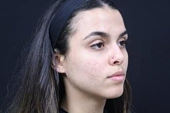 Skin Rejuvenation Before & After