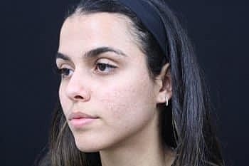 Skin Rejuvenation Before & After