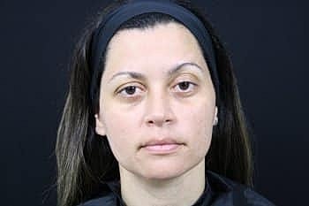 Skin Rejuvenation Before & After