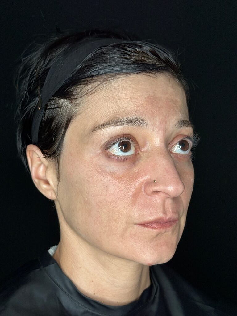 Facial Rejuvenation Before & After