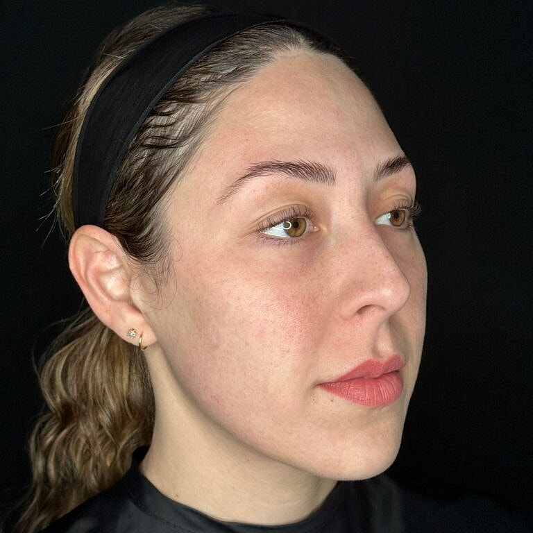 Facial Rejuvenation Before & After