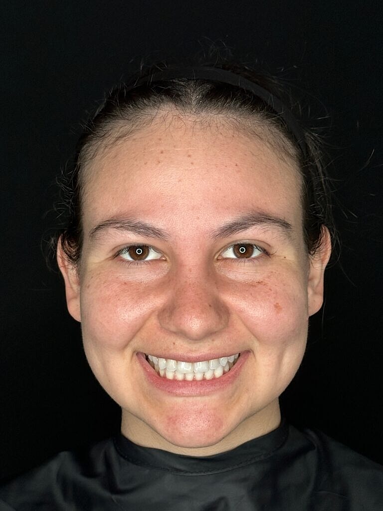 Thermage Before & After