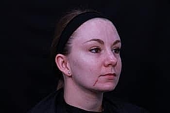 Woman with facial scars against black background.
