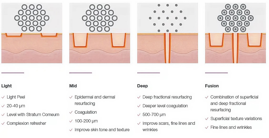 Skin treatment procedures: light, mid, deep, fusion.
